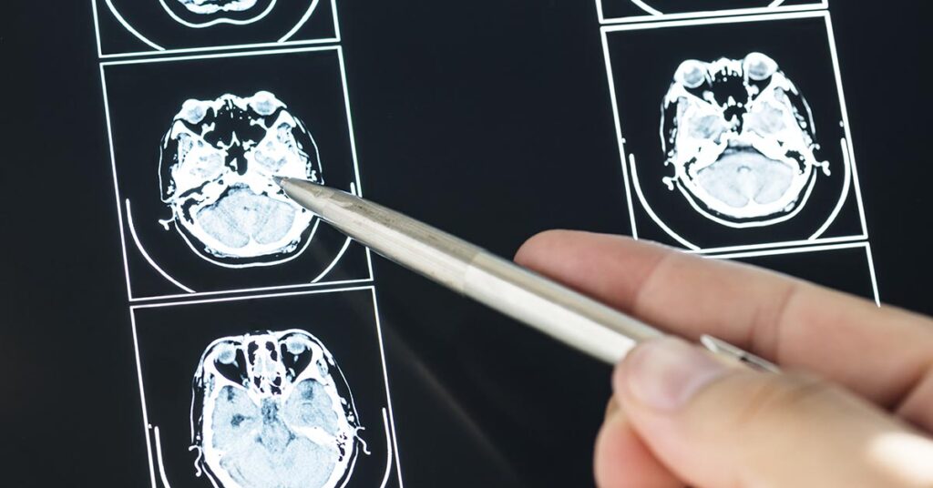 Quando procurar um neurologista? Sinais que indicam necessidade de avaliação